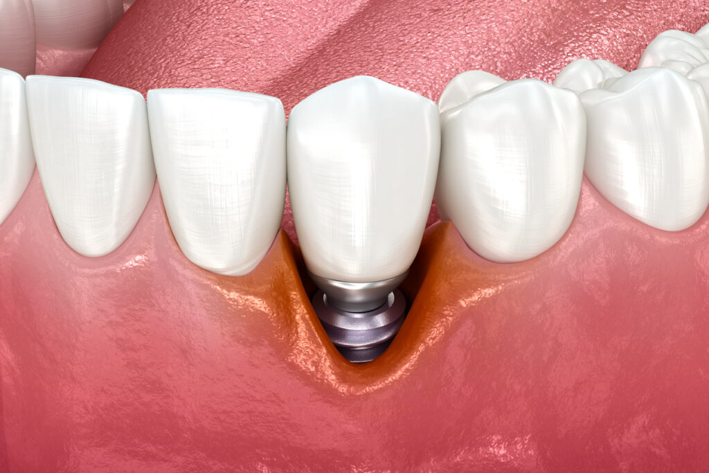 periimplantitis