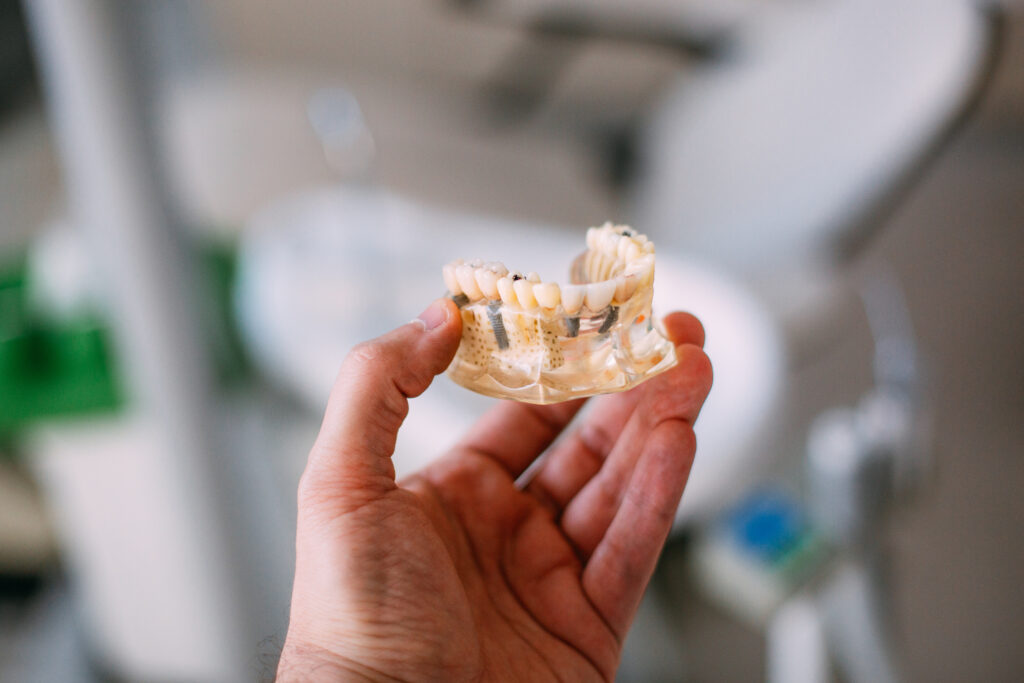 Implantes dentales de carga inmediata en Villaverde