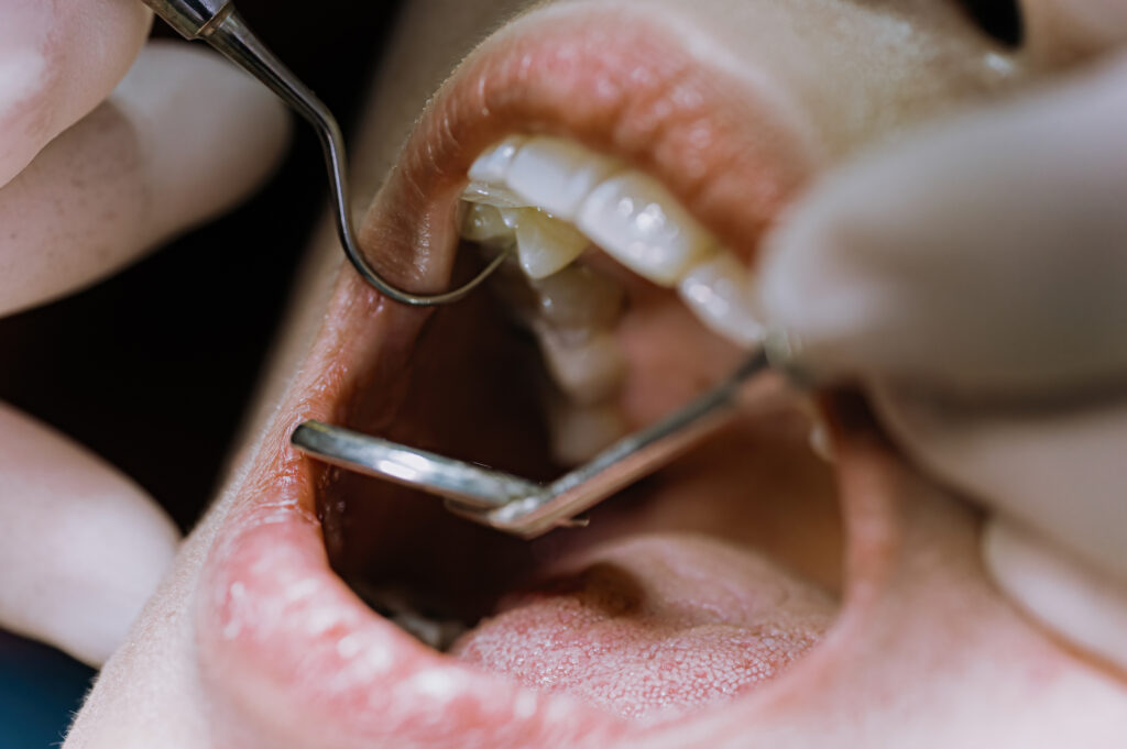 Sarro dental: qué es, qué puede causar y cómo eliminarlo