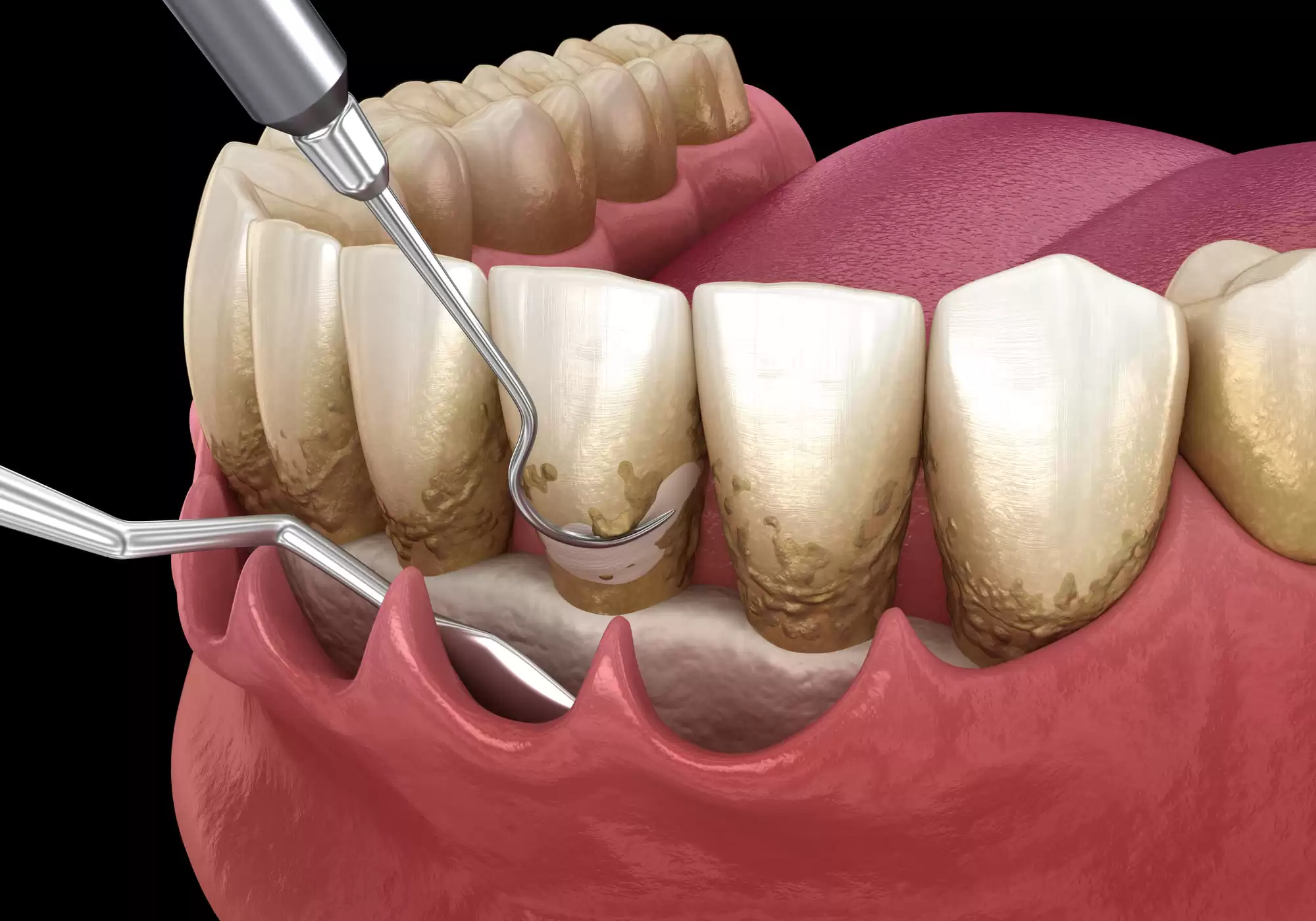 bolsas periodontales