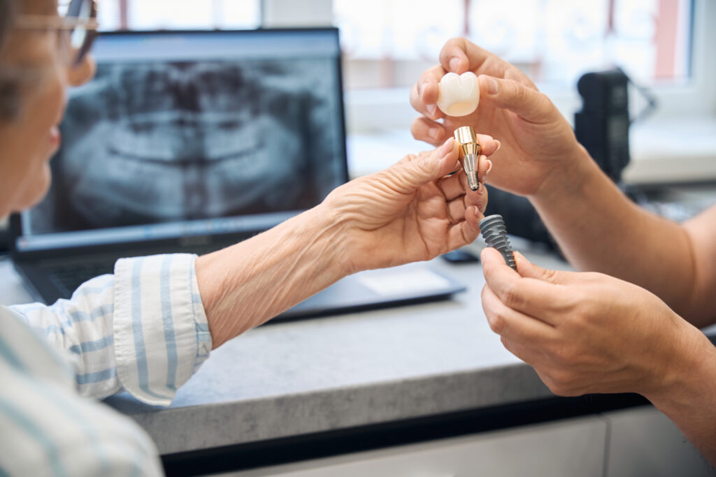 consejos para asegurar la estabilidad de los implantes dentales
