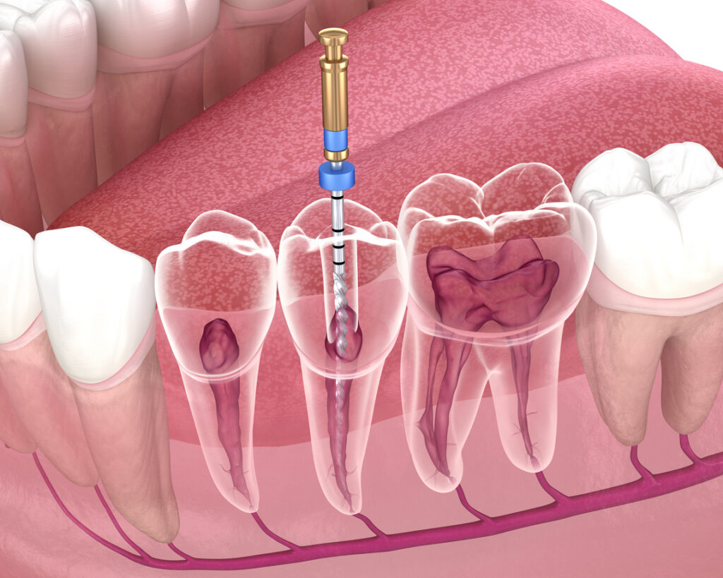 todo lo que debes saber sobre la endodoncia en Madrid