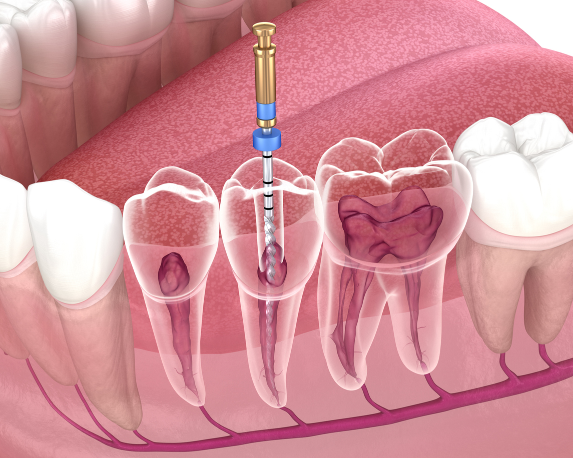 todo lo que debes saber sobre la endodoncia en Madrid