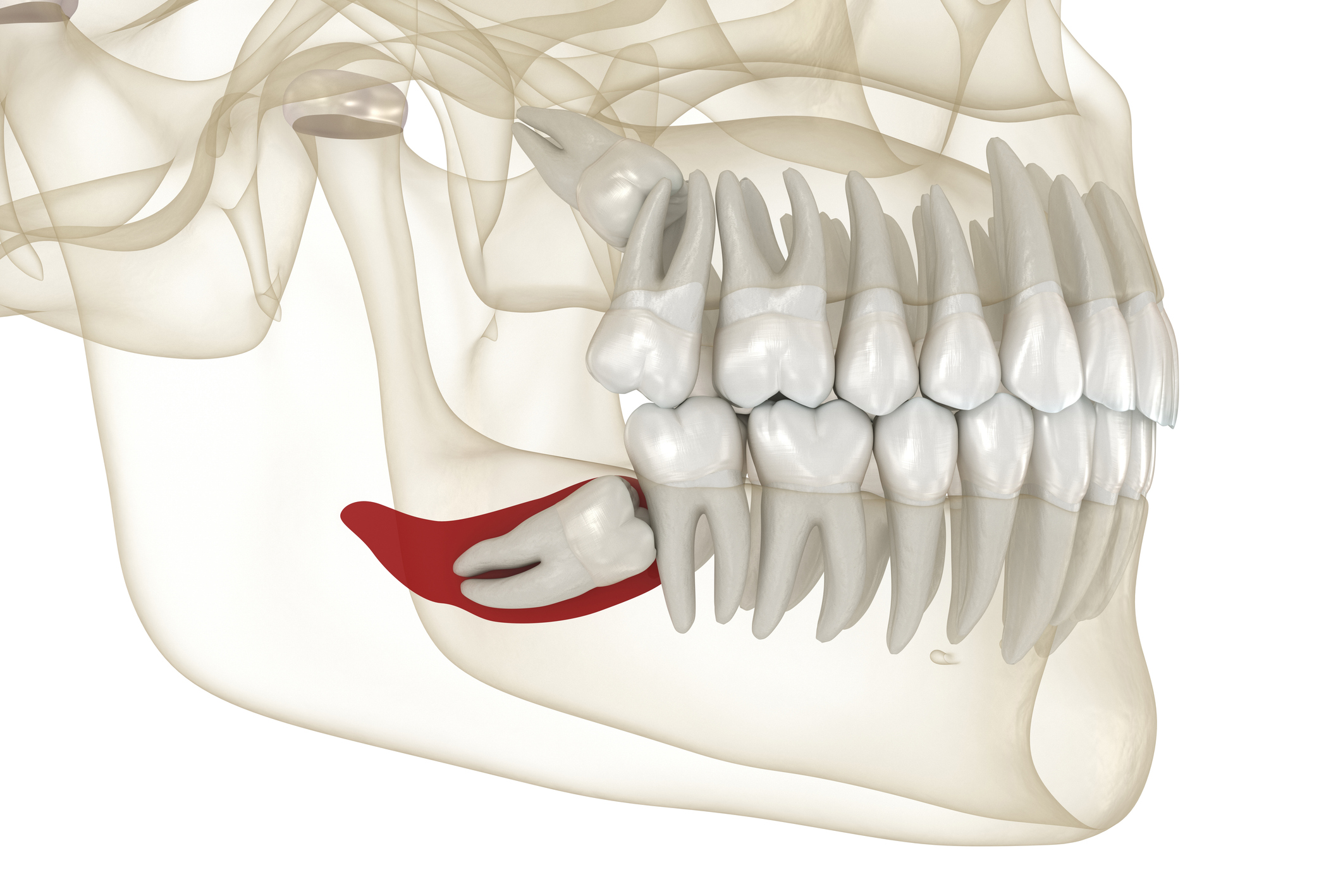 muelas del juicio en Villaverde