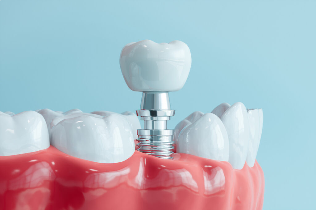 periimplantitis