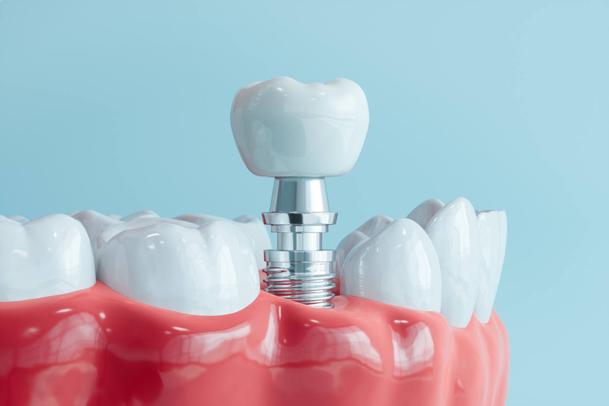 periimplantitis