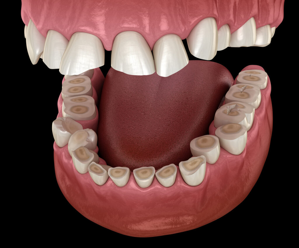 desgaste dental