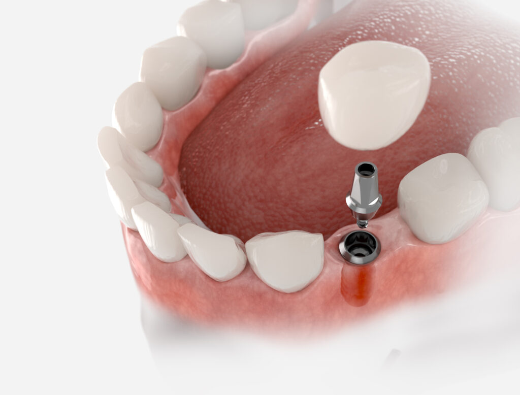 implantes de carga inmediata en Madrid