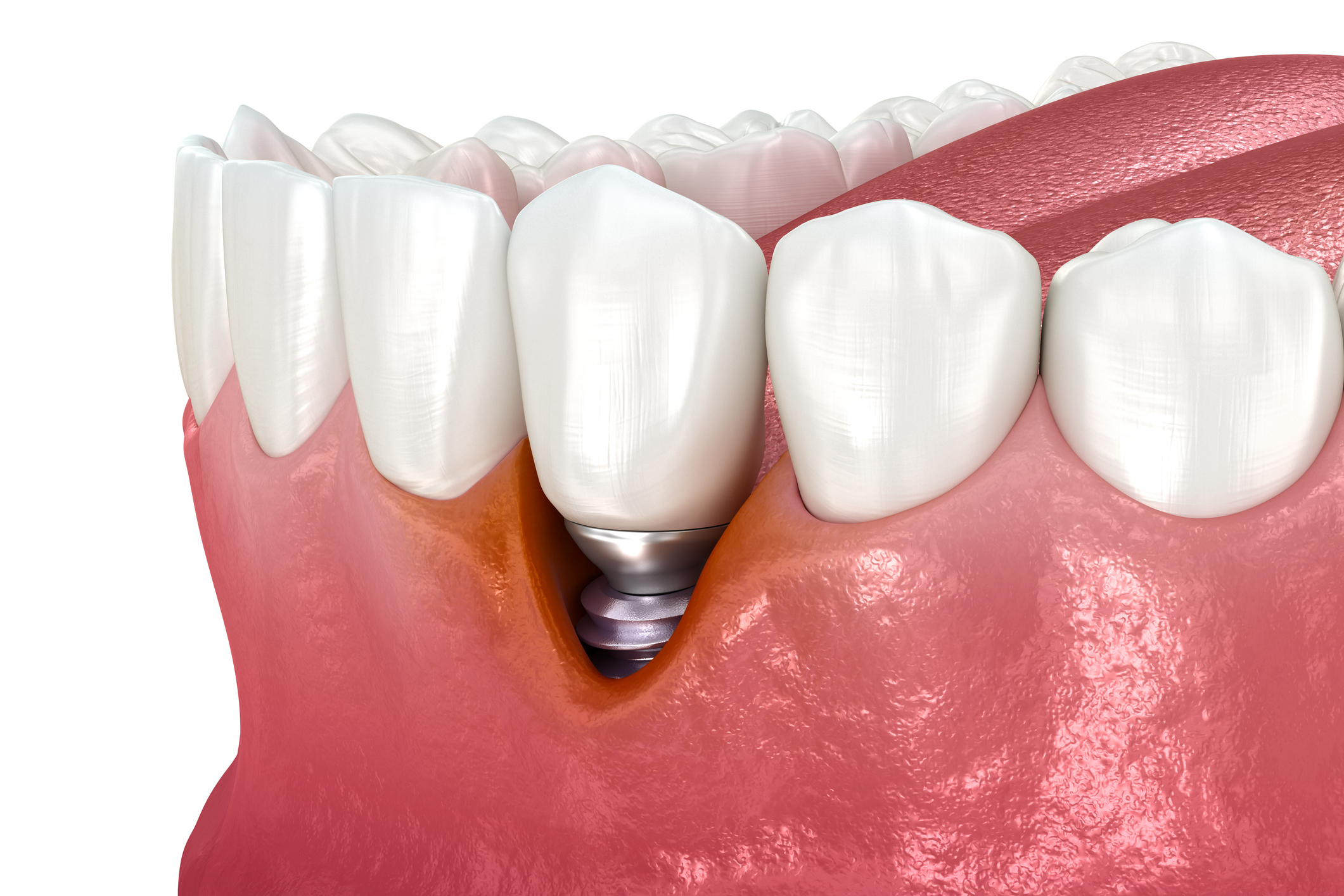 mucositis periimplantaria en Madrid