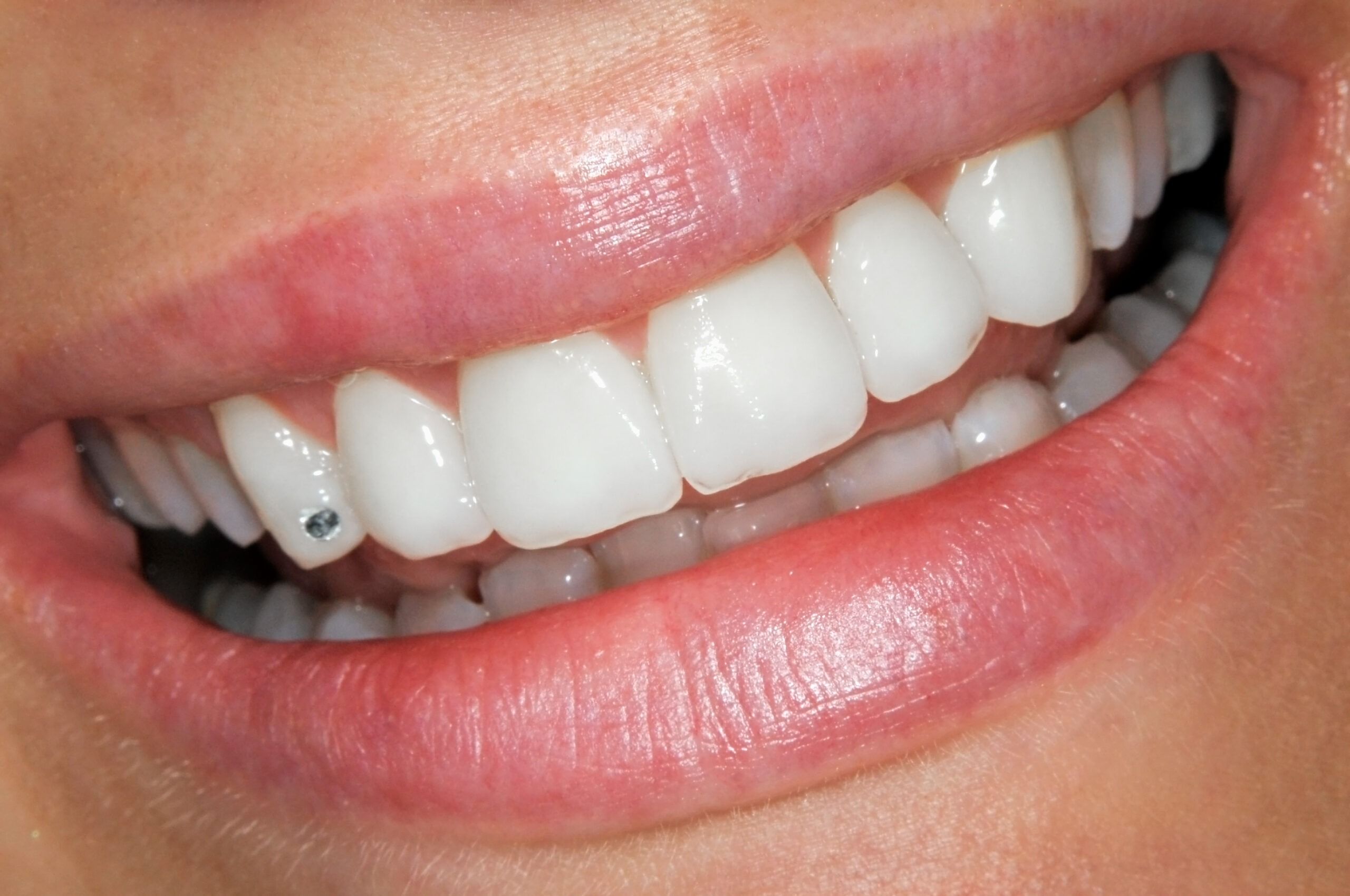gemas dentales