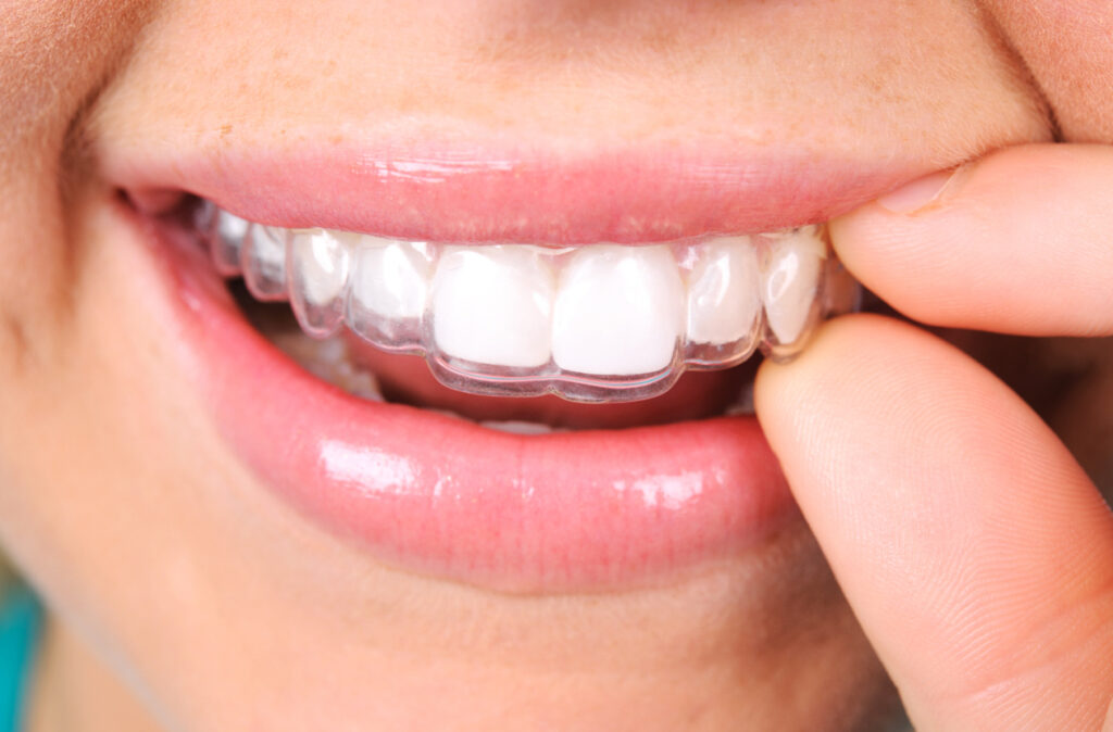 consecuencias de los dientes apiñados