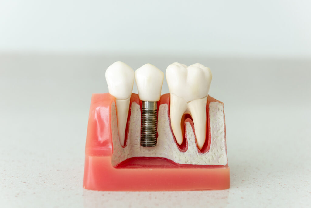 reabsorción ósea dental causas