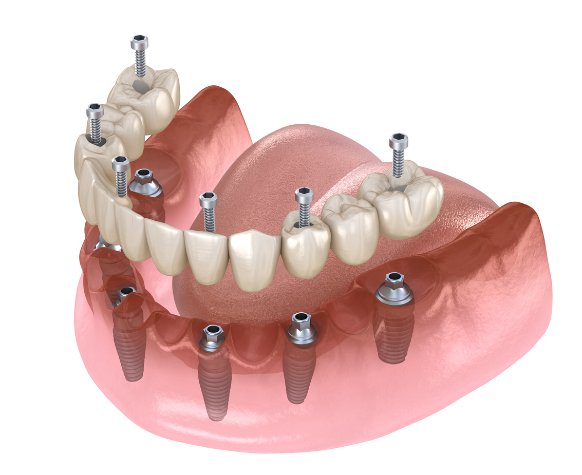 ventajas de las prótesis dentales fijas