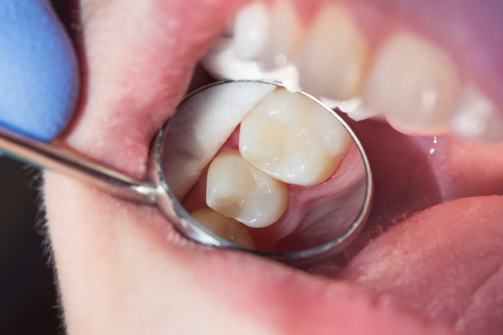 por qué se cae un empaste dental